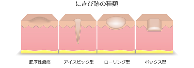 にきび跡の種類