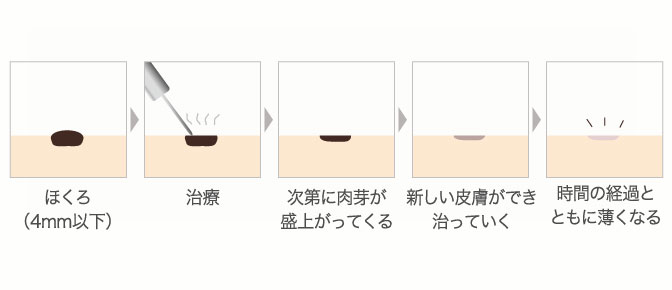 エルビウムヤグレーザーによるほくろ いぼの除去 札幌中央クリニック 美容外科 美容整形